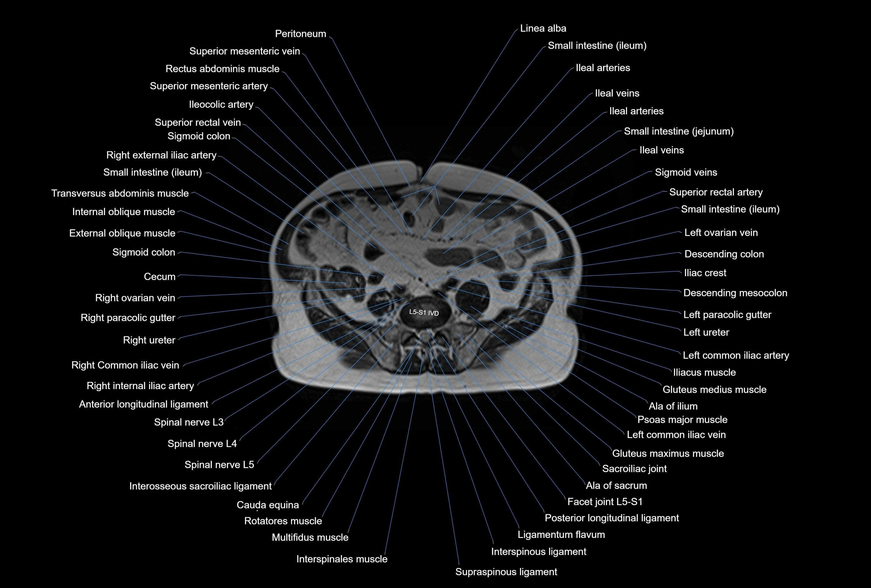 MRI Abdomen axial cross sectional anatomy radiology  image-img-00001-00038.webp
